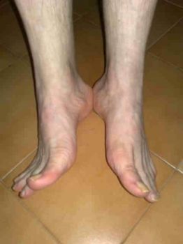 Piedi morti